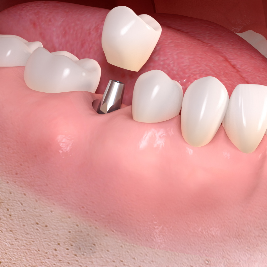 Advance Your Clinical Skills at the Dental Implant Restoration Course with Andrew Scott & Calum McNeil